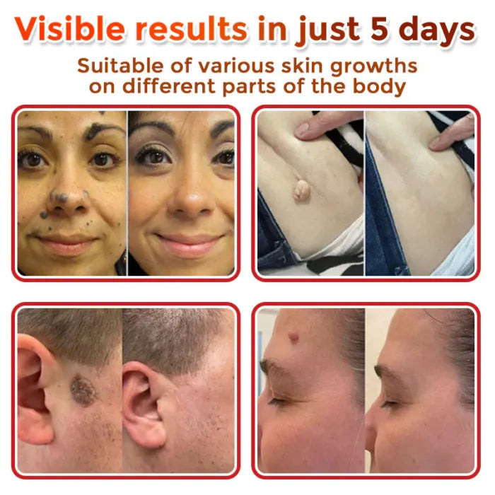 BelBexa ClearTag Microneedle Skin Tag Patch (Buy 1 Get 1 FREE)